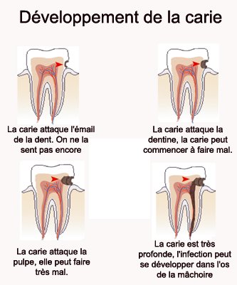 Imprimer l'&eacute;volution de la carie dentaire
