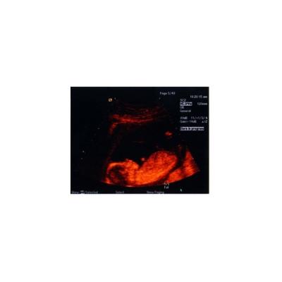 Troisième échographie de grossesse