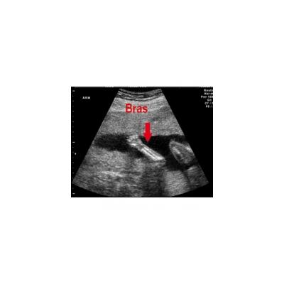Les mouvements du foetus à 3 mois de grossesse 