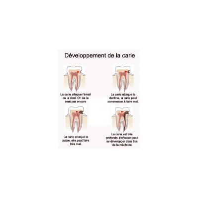 Développement de la carie