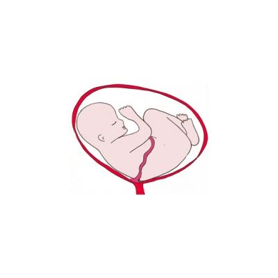La présentation par l'épaule. Bébé est pratiquement allongé horizontalement dans le ventre de sa mère. Bébé s