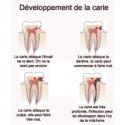 Développement de la carie