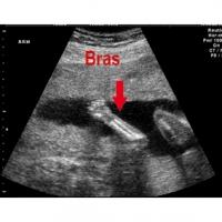 Les mouvements du foetus à 3 mois de grossesse 