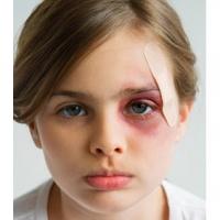 Comment soigner une blessure occulaire ? Que faire si mon enfant se blesse à l'oeil ? Les petites blessures aux yeux arrivent souvent en vacances et lors des jeux en plein air
