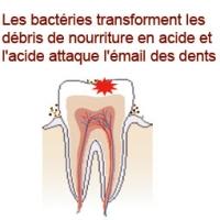 Les caries