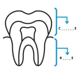 Imprimer l'activité sur la couronne et la racine de la dent