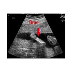 Les mouvements du foetus à 3 mois de grossesse 