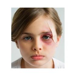 Comment soigner une blessure occulaire ? Que faire si mon enfant se blesse à l'oeil ? Les petites blessures aux yeux arrivent souvent en vacances et lors des jeux en plein air
