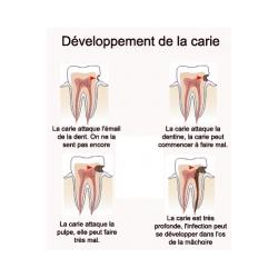 Développement de la carie