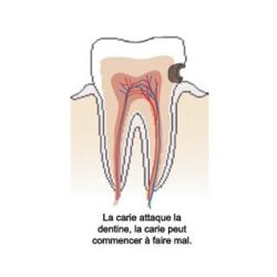 Carie de stade 2