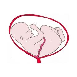 La présentation par l'épaule. Bébé est pratiquement allongé horizontalement dans le ventre de sa mère. Bébé s