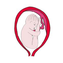 La présentation par le siège. Dans la présentation par le siège, bébé se présente les fesses les premières. Une présentation par le siège simple