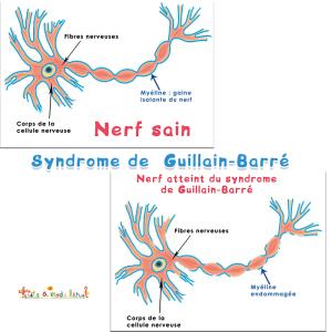 Le syndrome de Guillain-Barré, c’est quoi ?