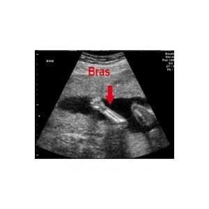 Les mouvements du foetus à 3 mois de grossesse 