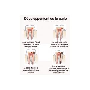 Développement de la carie
