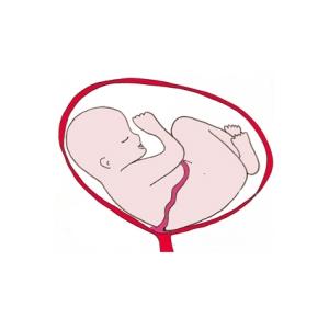La présentation par l'épaule. Bébé est pratiquement allongé horizontalement dans le ventre de sa mère. Bébé s