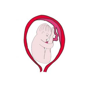 La présentation par le siège. Dans la présentation par le siège, bébé se présente les fesses les premières. Une présentation par le siège simple