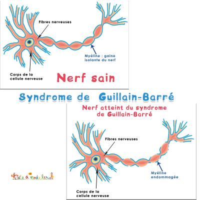 Le syndrome de Guillain-Barré, c’est quoi ?
